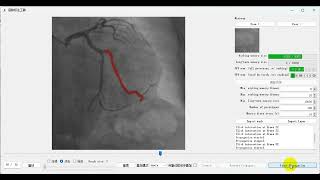 Tracking the coronary arteries through a temporal sequence of X-ray angiography images