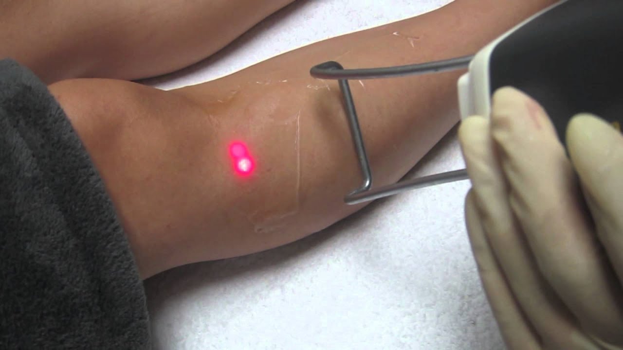 Laser Hair RemovalWhittierCovinaBreaLa HabraPasadenaFontana