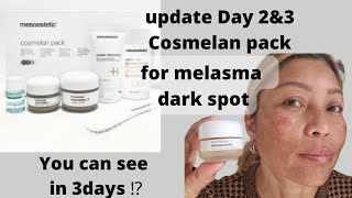 update Day 2 & 3 used Cosmelan pack for melasma and dark spots