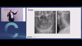 Posterior Stabilisation For C2 Fractures Scholz Eurospine 2025