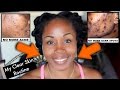 Get Rid of Acne Scars, Dark Spots and Hyperpigmentation | My NEW Daily Face Care Routine