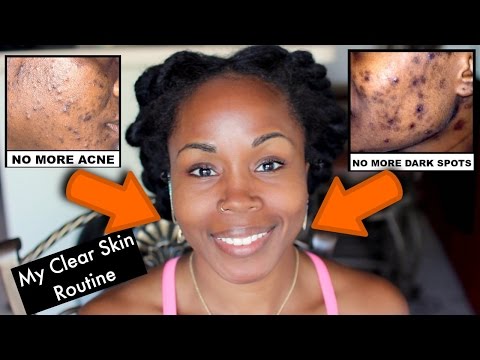 Get Rid of Acne Scars, Dark Spots and Hyperpigmentation | My NEW Daily Face Care Routine