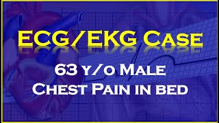 ECG/EKG Case: 63 y/o Male experiencing chest pain in bed.