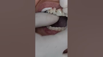 IVENEER Injectable matrix system: 0.05 IPR prior to matrix placement