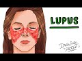 ¿QUÉ ES EL LUPUS? | Draw My Life