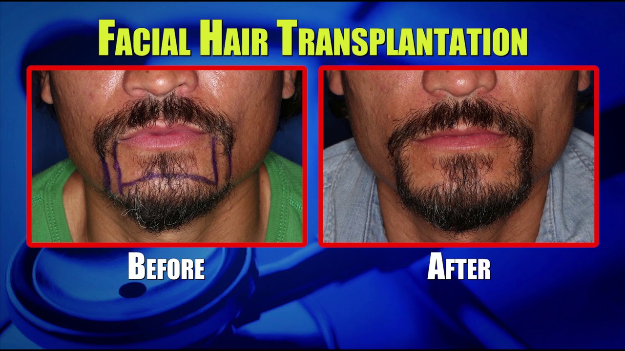 Beard Hair Transplant in Delhi  Beard Hair Transplant Cost in Delhi India   Dr As Clinic