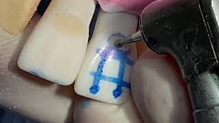 Class V cavity preparation