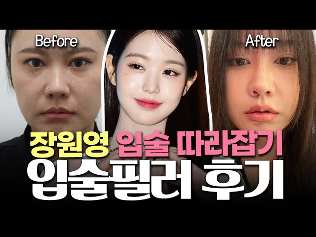 "원장님, 장원영 입술처럼 될까요?" 속광 입술필러 후기 in 차이클리닉