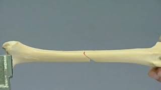 Mid-diaphyseal femoral fracture DCP buttress plate fixation