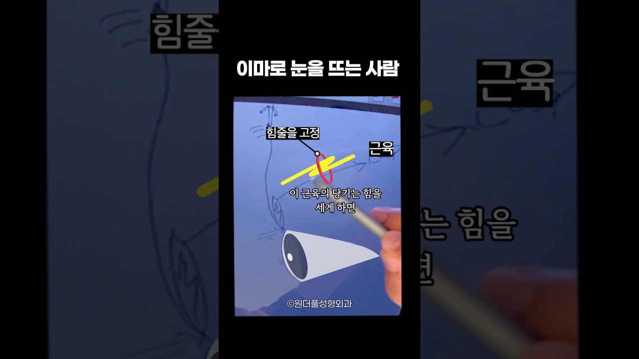 [Вондерфул Гоо Сайхны Мэс Заслын Эмнэлэг] Эрэгтэйчүүдийн дунд давхраа мэс засал шаардлагатай тохиолдлууд