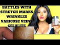 The faster way to get rid of STRETCH MARKS, GREEN VEINS AND WRINKLES