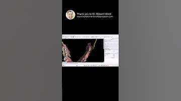 Educational Video: Crown Down Implant Planning #dentaleducation #dentist #dental #dentalcrowns