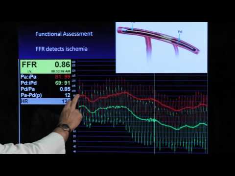 FFR Basics, Practice, Pitfalls - Mort Kern