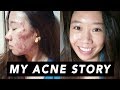 My Full Acne Story + Skincare Routine