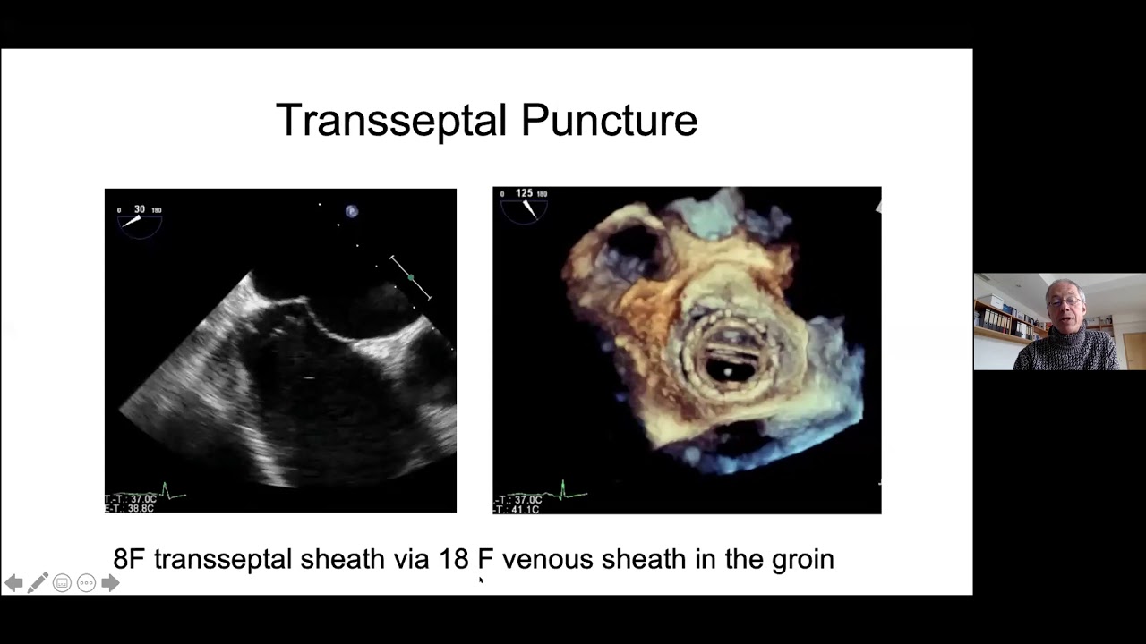 Paravalvular leak closure : indications, techniques and outcomes | H. Sievert (Allemagne)