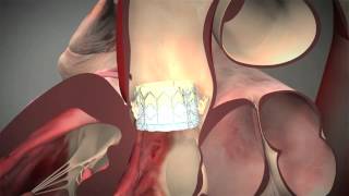 Ask The Expert: TAVR Procedure Explained By Dr. Charles Davidson