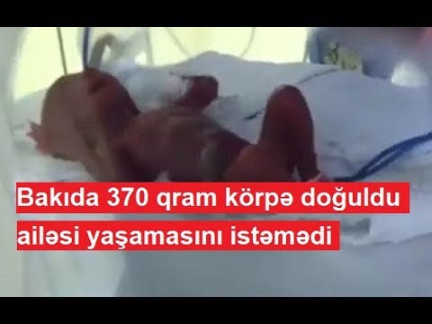 Video: Azərbaycanda Dəhşətli Dərəcədə Eybəcər Görünüşlü Körpə Dünyaya Gəlib