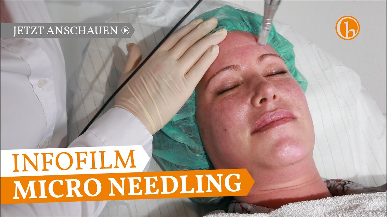 Micro Needling mit Pen - Dr. Simone Hellmann Plastische Chirurgie Köln