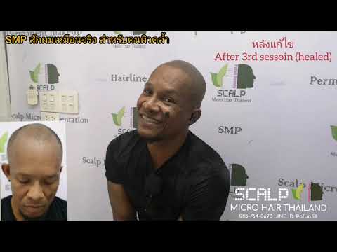 การดูแลรักษาหลังทำ SMP Scalp Micropigmentation for Dark skin By Pafan