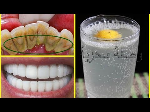 تبيض الاسنان - التخلص من جير الاسنان - علاج الرائحة الكريهة فى يوم واحد فقط. 