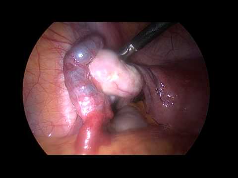 Fibroid Uterus, Retroverted Uterus, Ventrosuspension, Infertility, Painful Sex, Painful Period 1