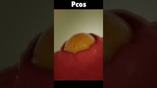 3d animation of polycystic ovaries 🥰#shorts #shortvideo #3danimation