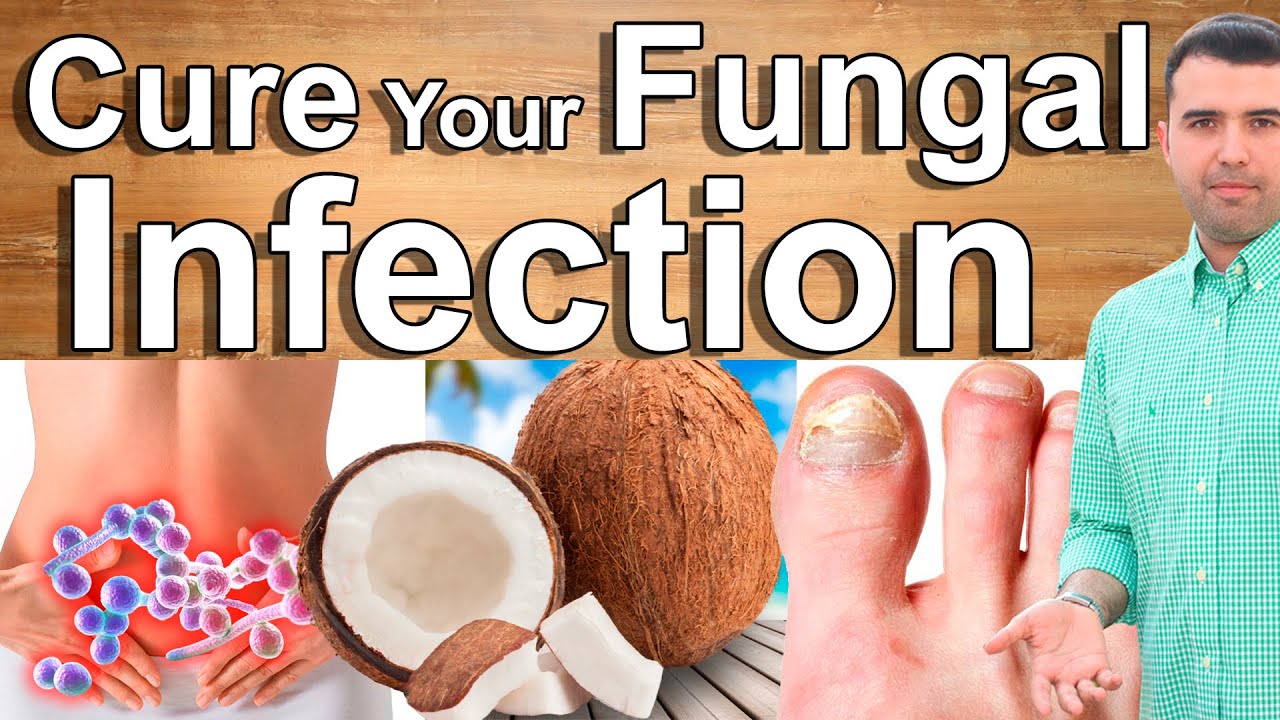 Eliminate Fungal Infections With These Home Remedies Say Goodbye