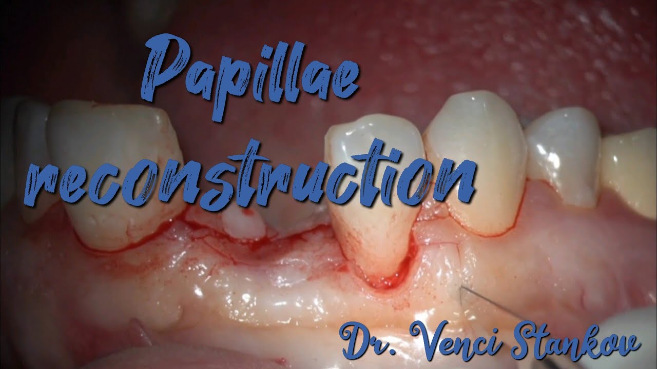 Papillae reconstruction in dental practice. Dental surgery operation
