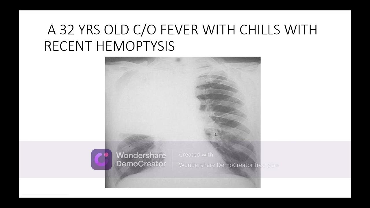 INTERPRETATION CHEST X RAYS QUIZ PART 3 QUESTIONS FOR PGs YouTube