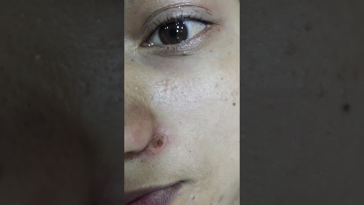 Mole remove by electric laser Nepal China Skin Care New Baneshwor