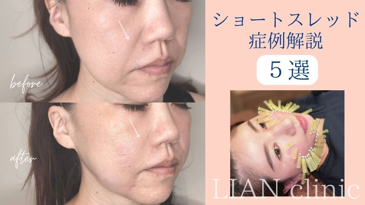 リアンの大人気施術【ショートスレッド】症例解説します！