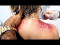 Extreme muscle scraping  chiropractic cracking emotional release