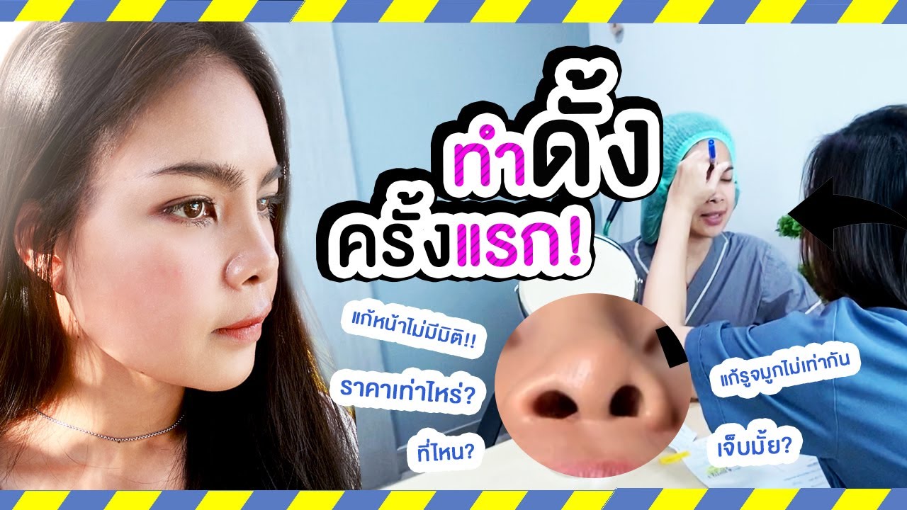 รีวิวเสริมจมูกครั้งแรก เจ็บมั้ย ช้ำหรือเปล่า ราคาเท่าไหร่  แถมยังเป็นภูมิแพ้ด้วย รอดไม่รอดมาดูกัน!! - Youtube