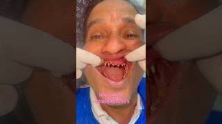 Dental Implant with Fix teeth within 7 days #implantsfixteeth #mumbaidental #ulwe