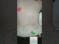 TEYS &amp; SACROILEITIS BILATERAL Y PINZAMIENTO