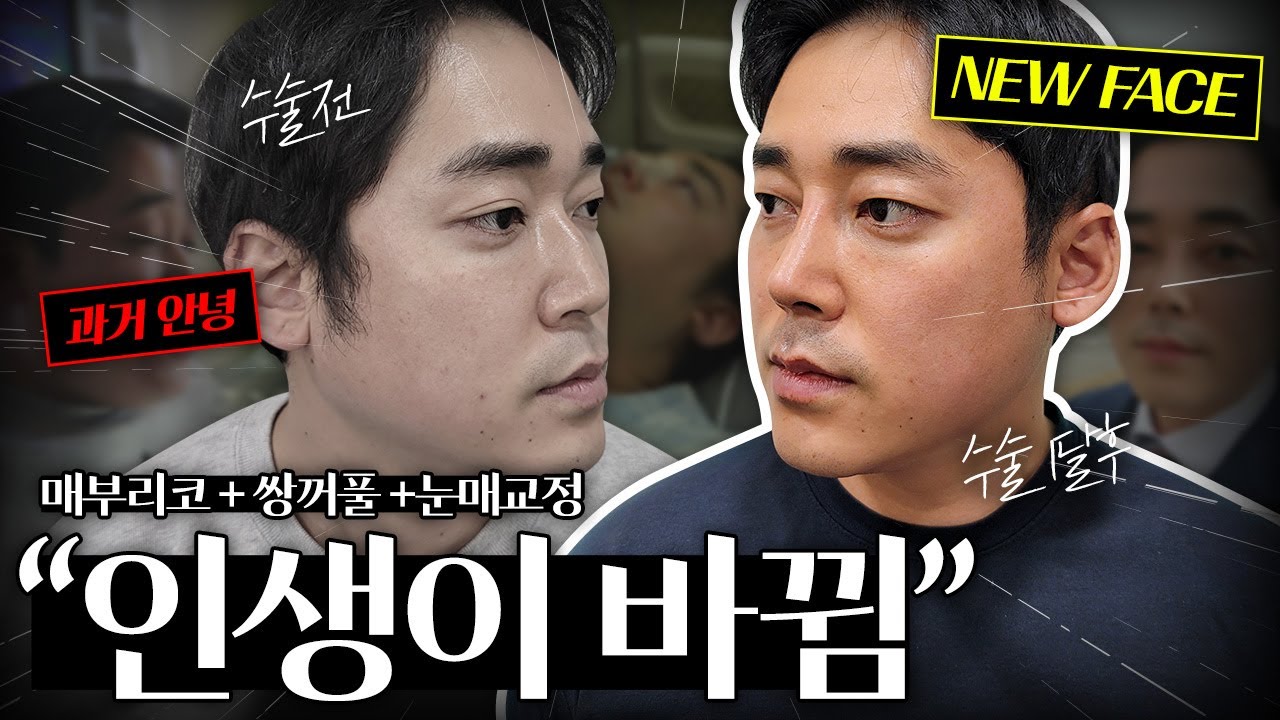 뉴페이스 훈남으로 업그레이드 성공🙋♂️ #쌍꺼풀 #눈매교정 #매부리코