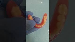 Daily Work Dentist. Removable Plate Denture Supported By Implants. T-Ecco Clasps.