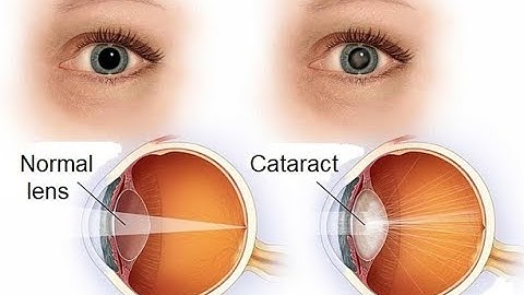 Removal of intraocular lens CPT code - simplify medical coding