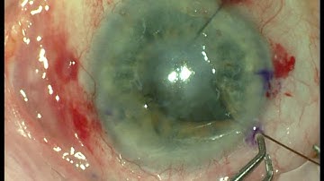 Pupil Dilation Techniques