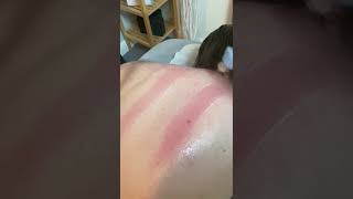 Upper Back Pain Shockwave Therapy Upper Back Pain Shockwave This Structure