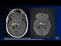 Neuroradiology board review lecture 1 case 10