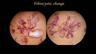 Fibrocystic change mp4 patched Fibrocystic change mp4 patched