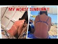 Worst sunburn ever