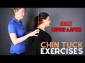 Chin Tuck Exercise - Before and After text neck