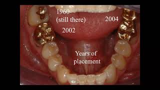 Posterior Direct Composites - Dr. Joel N. Janis
