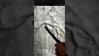 High-Risk Pci Elderly With Respiratory Failure Critical Lm Cad, Ivus-Guided Pci T-Technique