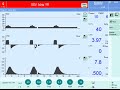 Synchronized intermittent mandatory ventilation simv