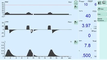 Synchronized Intermittent Mandatory Ventilation (SIMV)