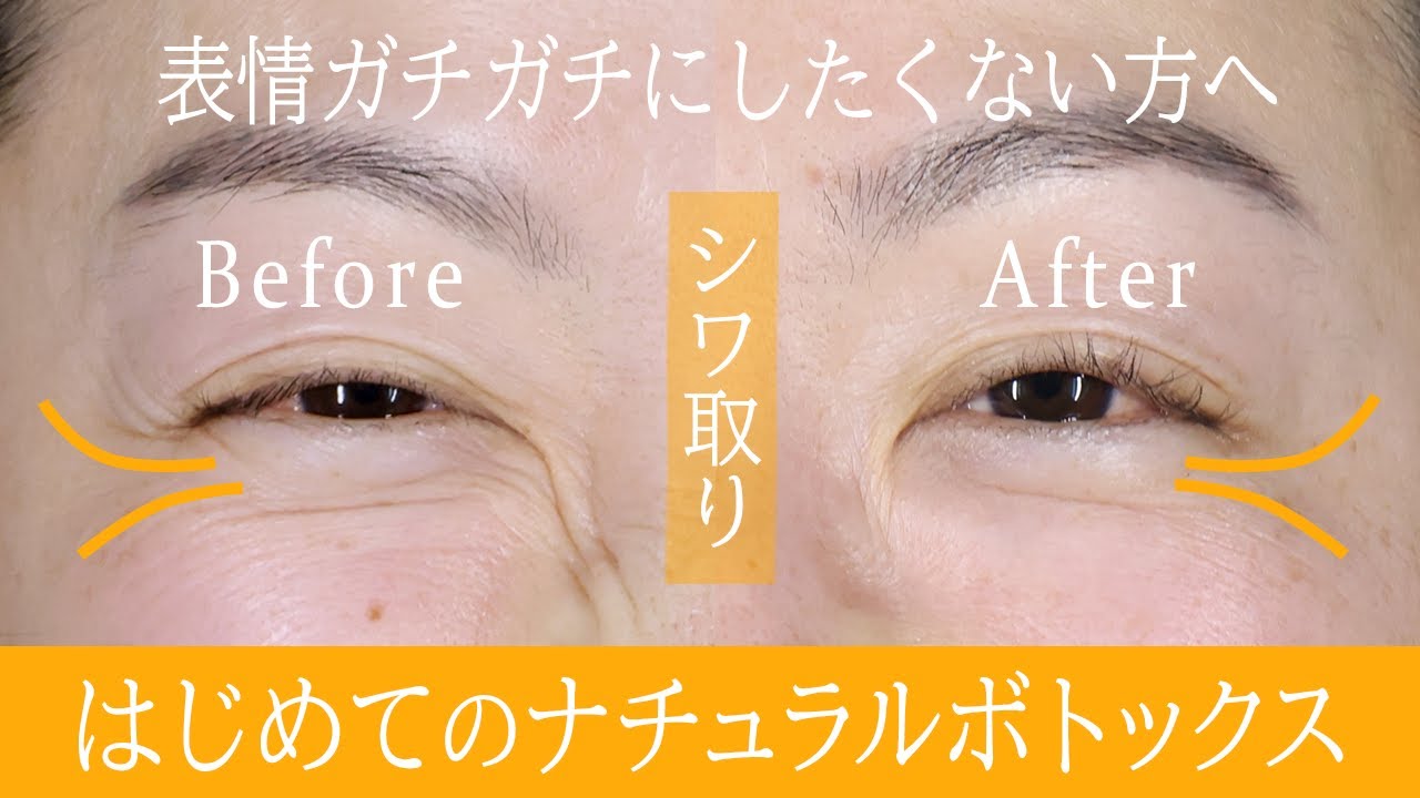 ボトックスは顔固まる 固まらない方法あります シワを薄く自然な表情に仕上げた ナチュラルボトックス症例2選 初心者もok 湘南美容クリニック Youtube