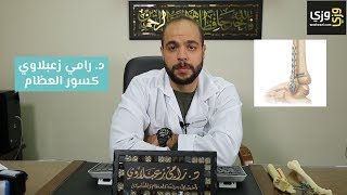 أنواع كسور العظام وكيفية علاجها